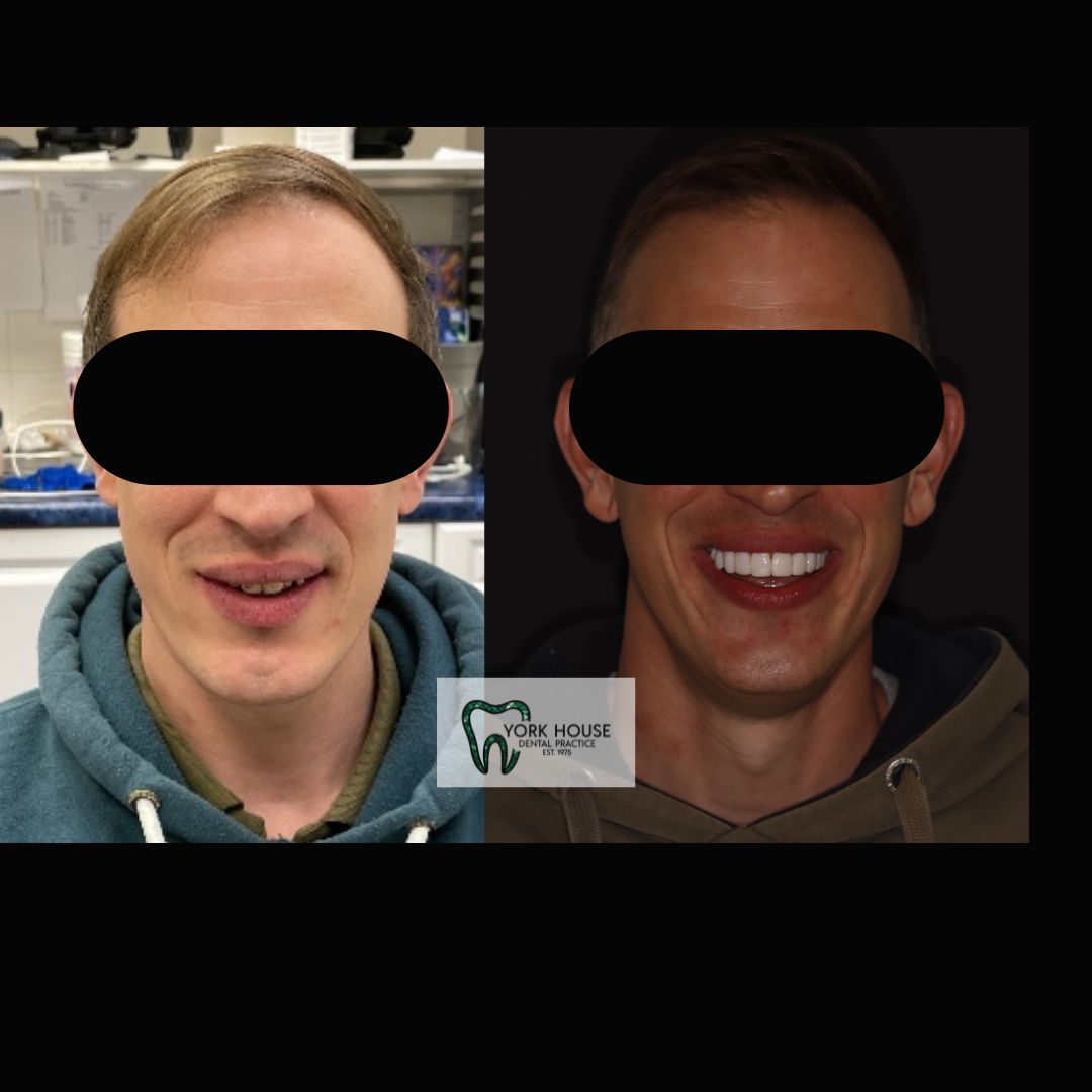 Smile Transformation 1 after treatment at York House Dental Practice