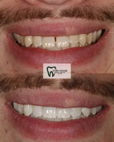 cosmetic dentistry West Byfleet - Case Invisalign Case 1 before and after result