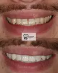 Before and after Invisalign Case 1 thumbnail result - dentist in West Byfleet