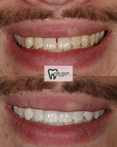 cosmetic dentistry West Byfleet - Case Invisalign Case 1 before and after result