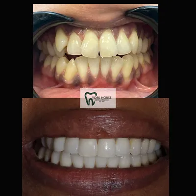 cosmetic dentistry West Byfleet - Case Smile Transformation 10 before and after result