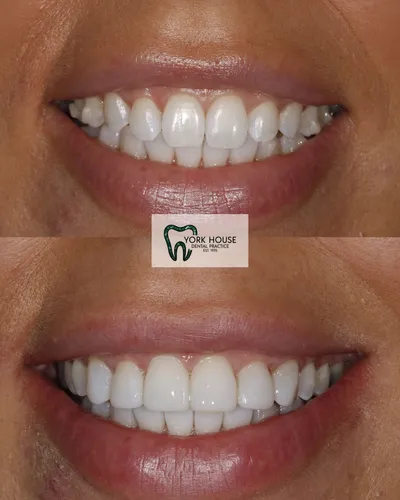 cosmetic dentistry West Byfleet - Case Invisalign Case 10 before and after result