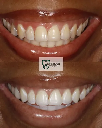 cosmetic dentistry West Byfleet - Case Invisalign Case 11 before and after result