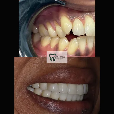 cosmetic dentistry West Byfleet - Case Smile Transformation 11 before and after result