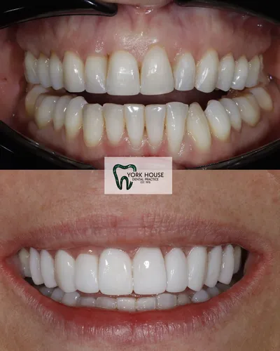 cosmetic dentistry West Byfleet - Case Invisalign Case 12 before and after result