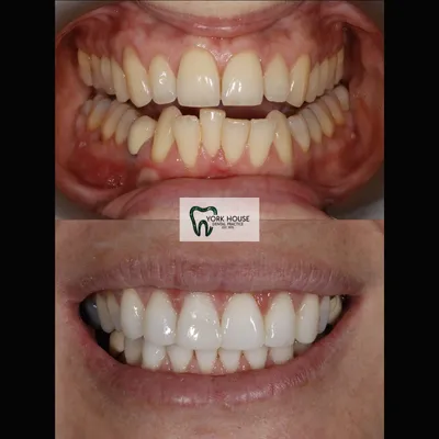cosmetic dentistry West Byfleet - Case Smile Transformation 12 before and after result