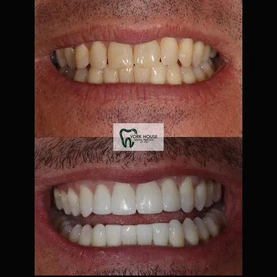 cosmetic dentistry West Byfleet - Case Smile Transformation 13 before and after result