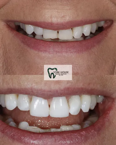 cosmetic dentistry West Byfleet - Case Invisalign Case 13 before and after result