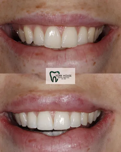 cosmetic dentistry West Byfleet - Case Invisalign Case 14 before and after result