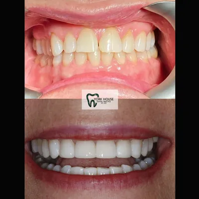 cosmetic dentistry West Byfleet - Case Smile Transformation 14 before and after result