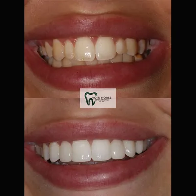 cosmetic dentistry West Byfleet - Case Smile Transformation 15 before and after result