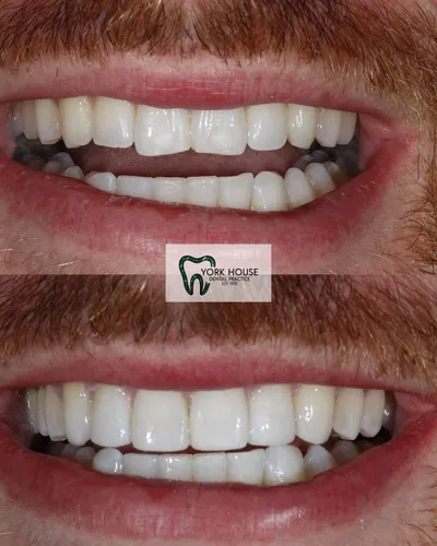 cosmetic dentistry West Byfleet - Case Invisalign Case 15 before and after result