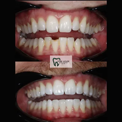 cosmetic dentistry West Byfleet - Case Smile Transformation 16 before and after result