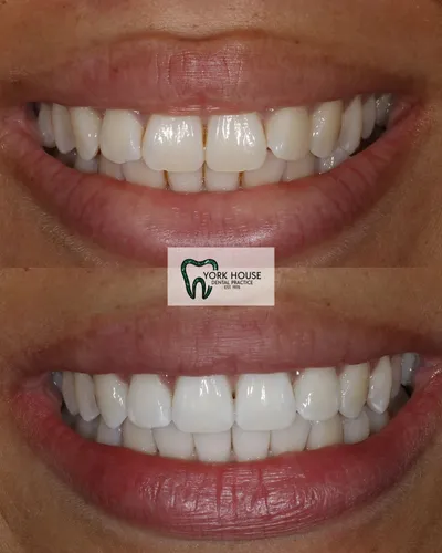 cosmetic dentistry West Byfleet - Case Invisalign Case 16 before and after result