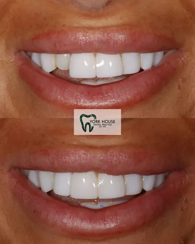 cosmetic dentistry West Byfleet - Case Invisalign Case 17 before and after result