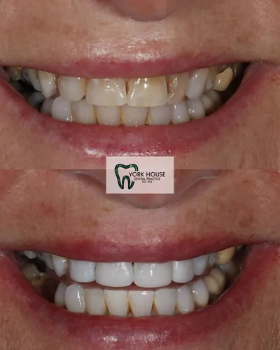 cosmetic dentistry West Byfleet - Case Invisalign Case 18 before and after result