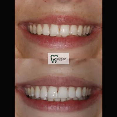 cosmetic dentistry West Byfleet - Case Smile Transformation 19 before and after result