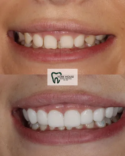 cosmetic dentistry West Byfleet - Case Invisalign Case 19 before and after result