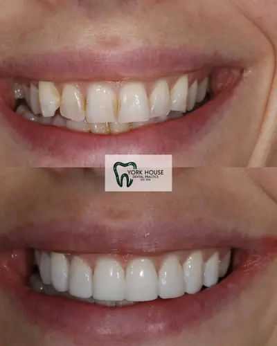 cosmetic dentistry West Byfleet - Case Invisalign Case 2 before and after result