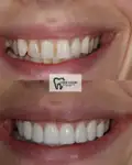 Before and after Invisalign Case 2 thumbnail result - dentist in West Byfleet