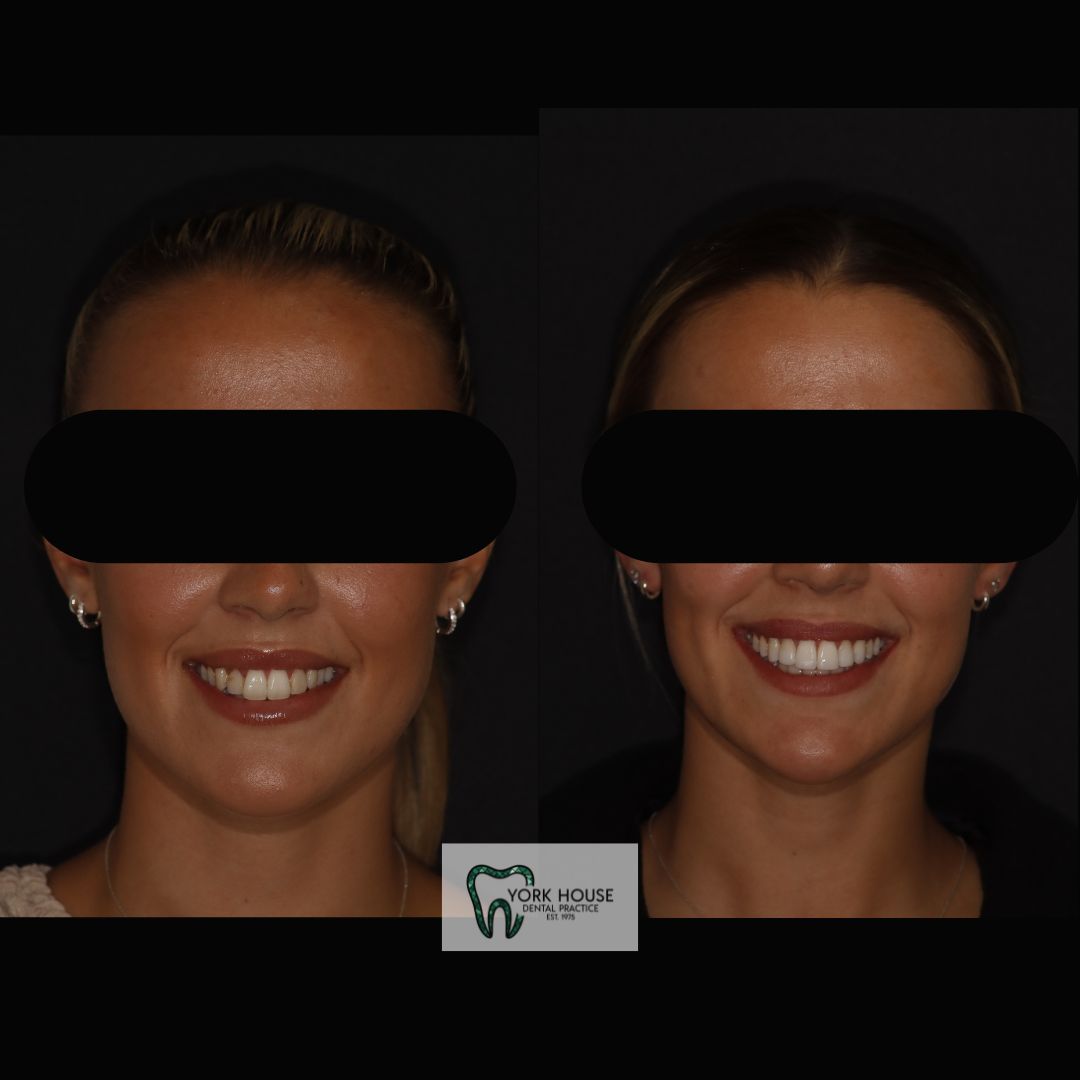 Smile Transformation 2 after treatment at York House Dental Practice
