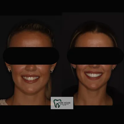 cosmetic dentistry West Byfleet - Case Smile Transformation 2 before and after result