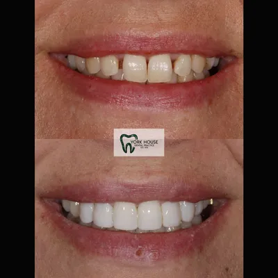 cosmetic dentistry West Byfleet - Case Smile Transformation 20 before and after result