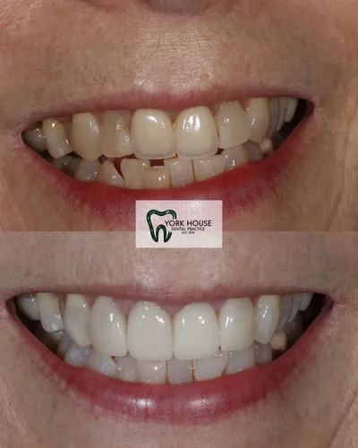 cosmetic dentistry West Byfleet - Case Invisalign Case 20 before and after result