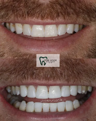 cosmetic dentistry West Byfleet - Case Invisalign Case 21 before and after result