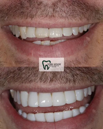 cosmetic dentistry West Byfleet - Case Invisalign Case 22 before and after result