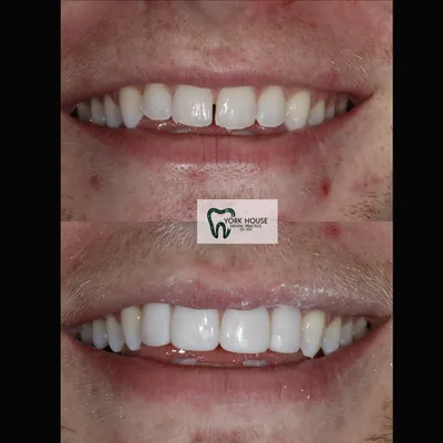 cosmetic dentistry West Byfleet - Case Smile Transformation 23 before and after result