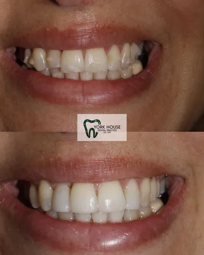 cosmetic dentistry West Byfleet - Case Invisalign Case 23 before and after result