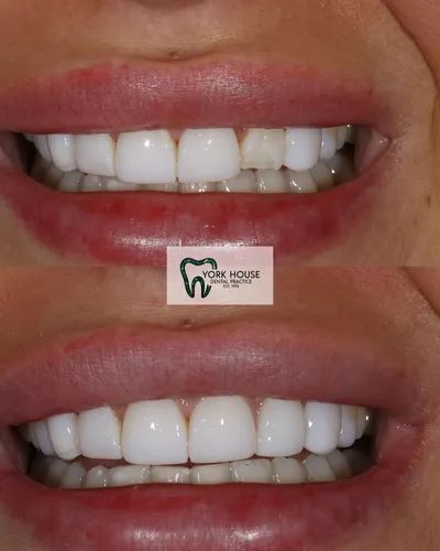 cosmetic dentistry West Byfleet - Case Invisalign Case 24 before and after result