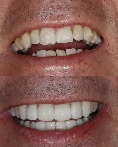 cosmetic dentistry West Byfleet - Case Invisalign Case 25 before and after result