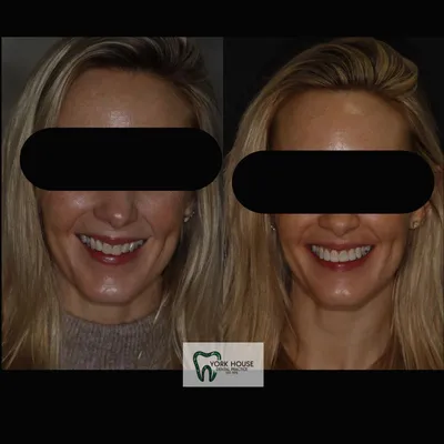 cosmetic dentistry West Byfleet - Case Smile Transformation 25 before and after result