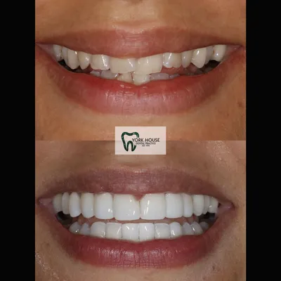 cosmetic dentistry West Byfleet - Case Smile Transformation 27 before and after result