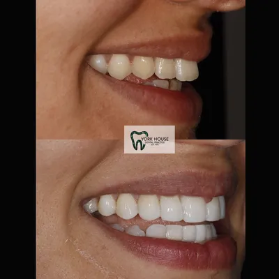 cosmetic dentistry West Byfleet - Case Smile Transformation 28 before and after result