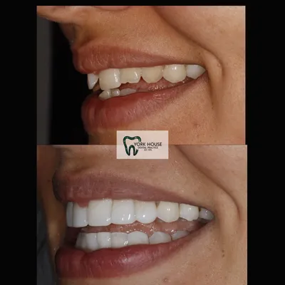 cosmetic dentistry West Byfleet - Case Smile Transformation 29 before and after result