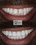 Before and after Invisalign Case 3 thumbnail result - dentist in West Byfleet