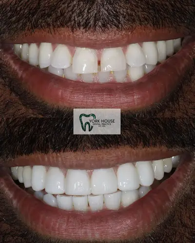 cosmetic dentistry West Byfleet - Case Invisalign Case 3 before and after result