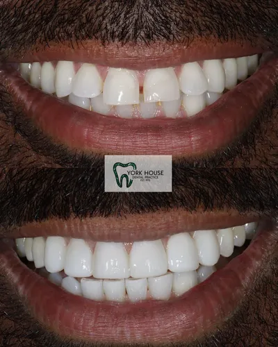 cosmetic dentistry West Byfleet - Case Invisalign Case 3 before and after result