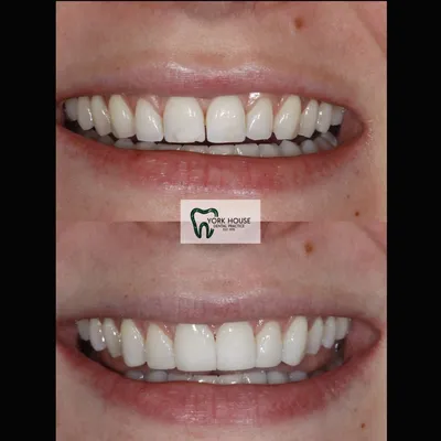 cosmetic dentistry West Byfleet - Case Smile Transformation 30 before and after result