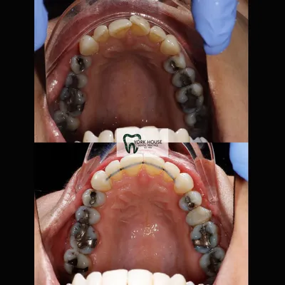 cosmetic dentistry West Byfleet - Case Smile Transformation 31 before and after result