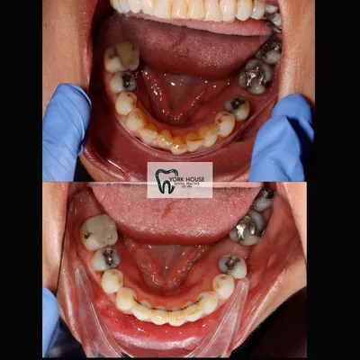 cosmetic dentistry West Byfleet - Case Smile Transformation 32 before and after result