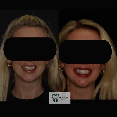 cosmetic dentistry West Byfleet - Case Smile Transformation 33 before and after result