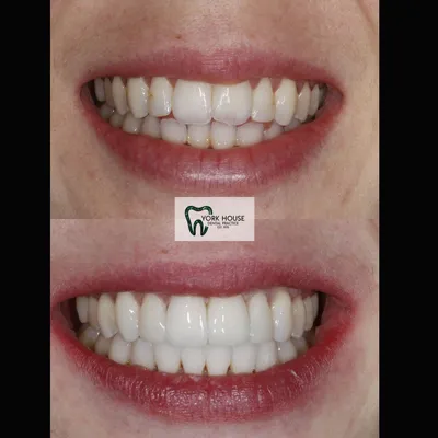 cosmetic dentistry West Byfleet - Case Smile Transformation 34 before and after result
