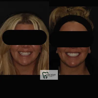 cosmetic dentistry West Byfleet - Case Smile Transformation 35 before and after result