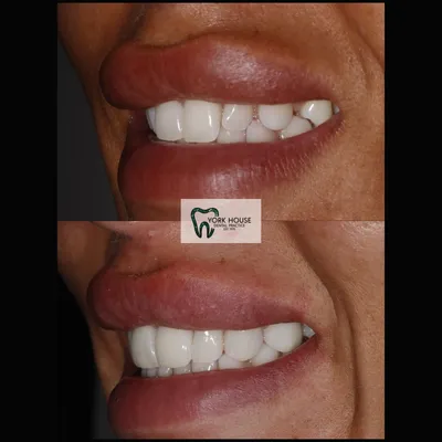 cosmetic dentistry West Byfleet - Case Smile Transformation 36 before and after result