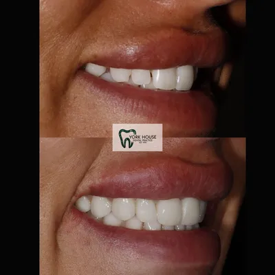 cosmetic dentistry West Byfleet - Case Smile Transformation 37 before and after result