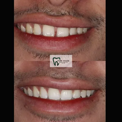 cosmetic dentistry West Byfleet - Case Smile Transformation 38 before and after result